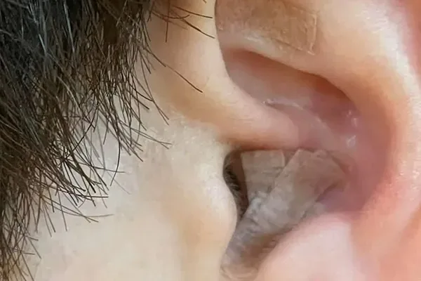 運動せずに痩せられる「耳つぼファスティング」